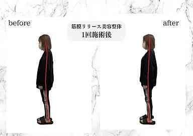 筋膜リリース美容整体