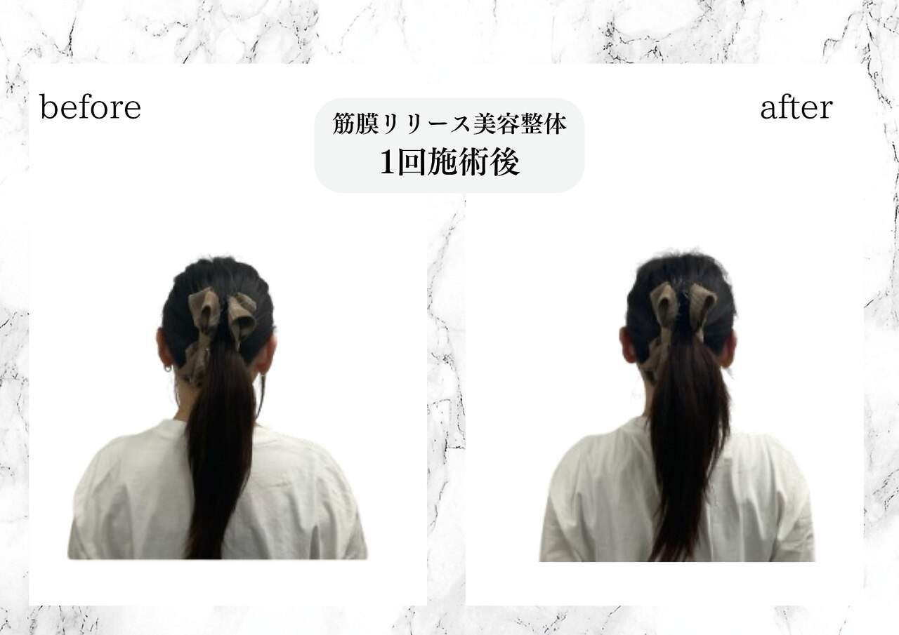 筋膜リリース美容整体