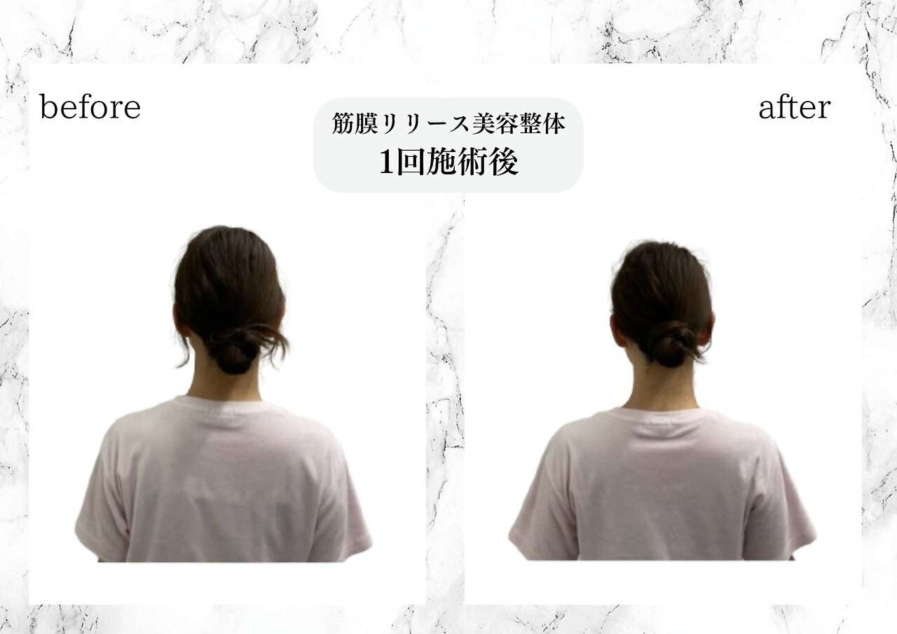 筋膜リリース美容整体