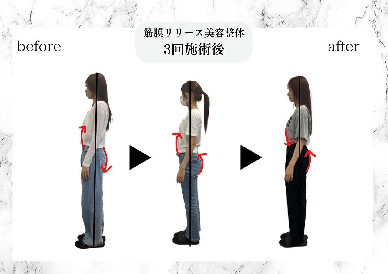 筋膜リリース美容整体