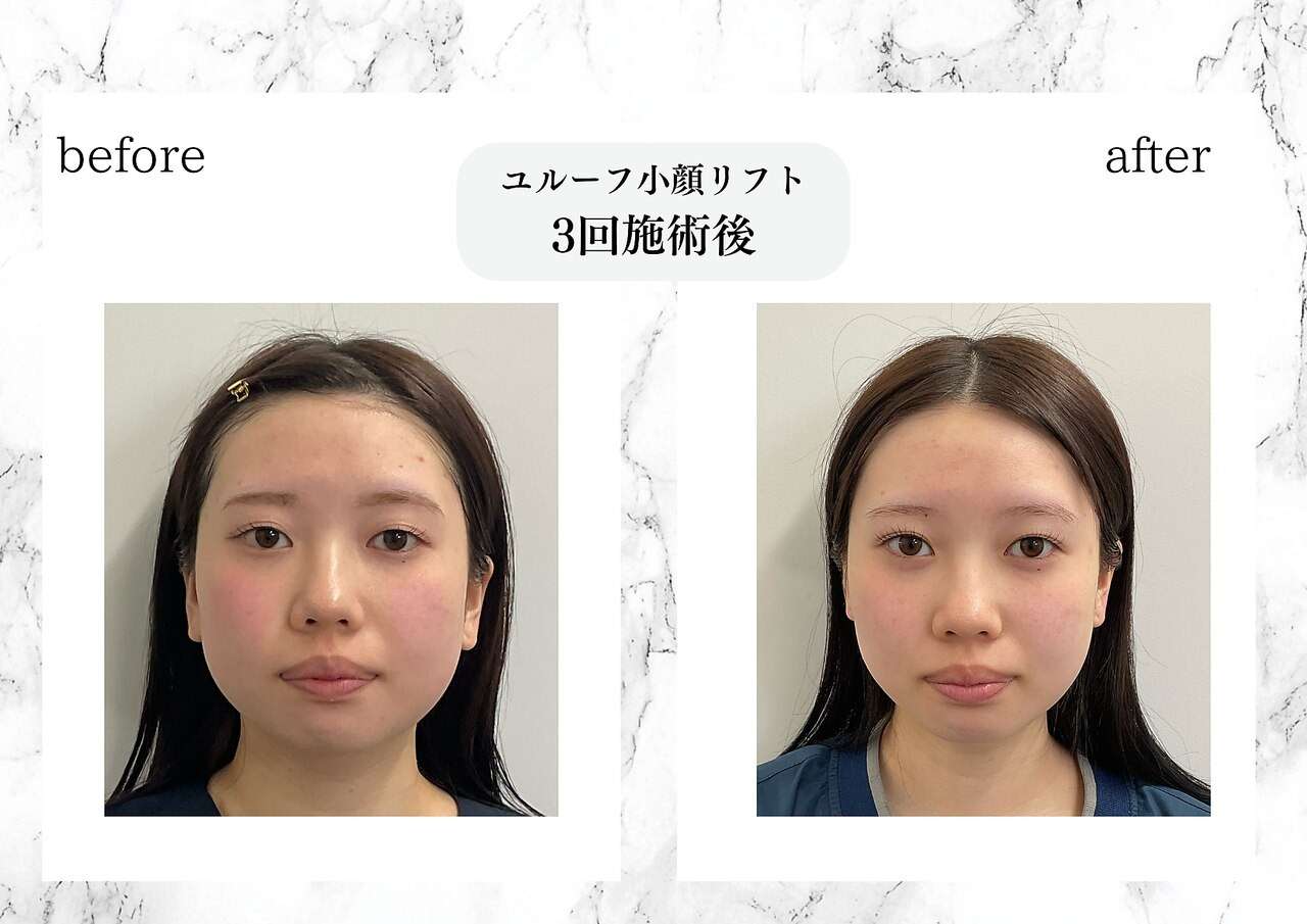 ユルーフ小顔リフト　3回施術後