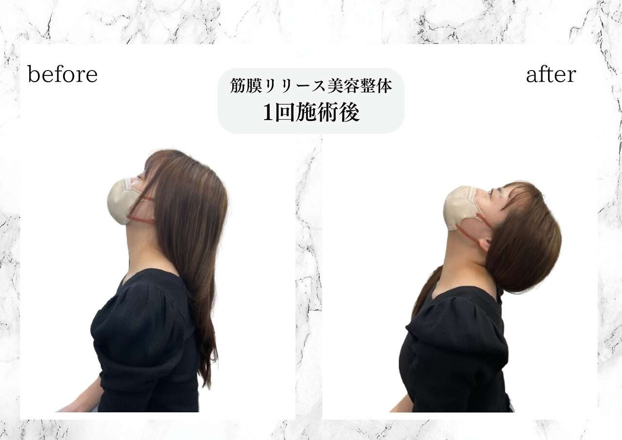 筋膜リリース美容整体　施術直後