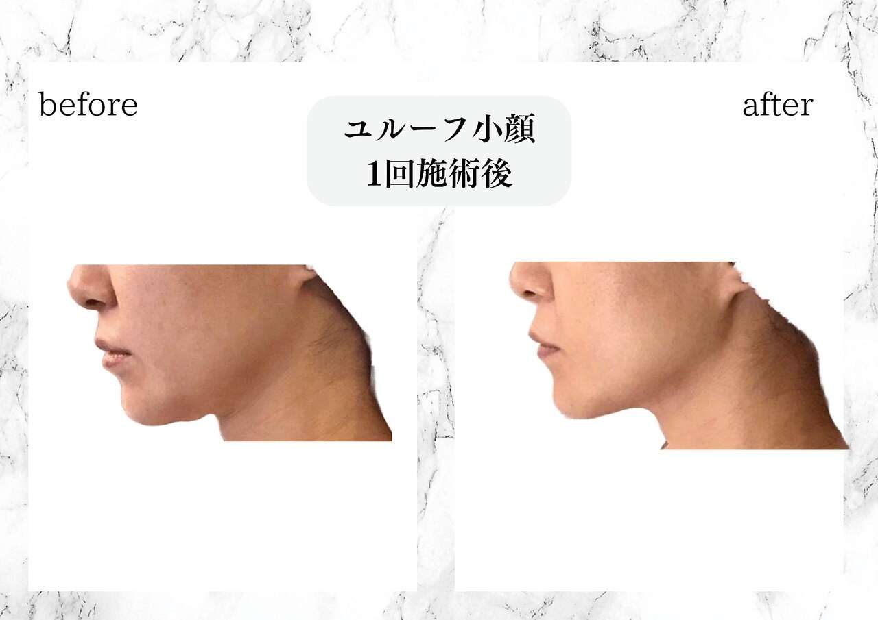 ユルーフ超音波小顔リフト　直後