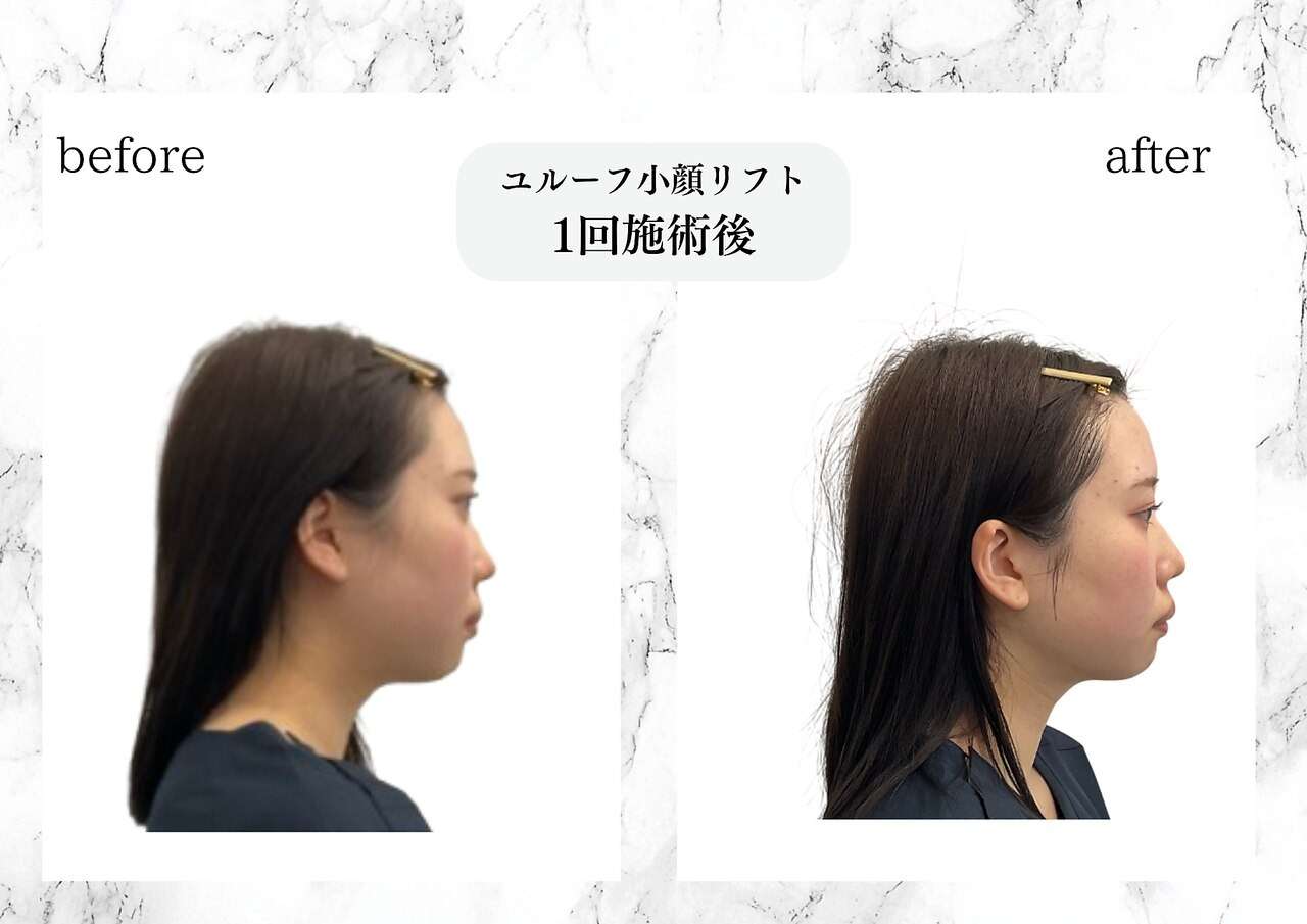 ユルーフ小顔リフト　1回施術