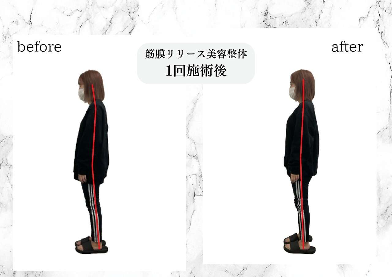筋膜リリース美容整体　施術直後