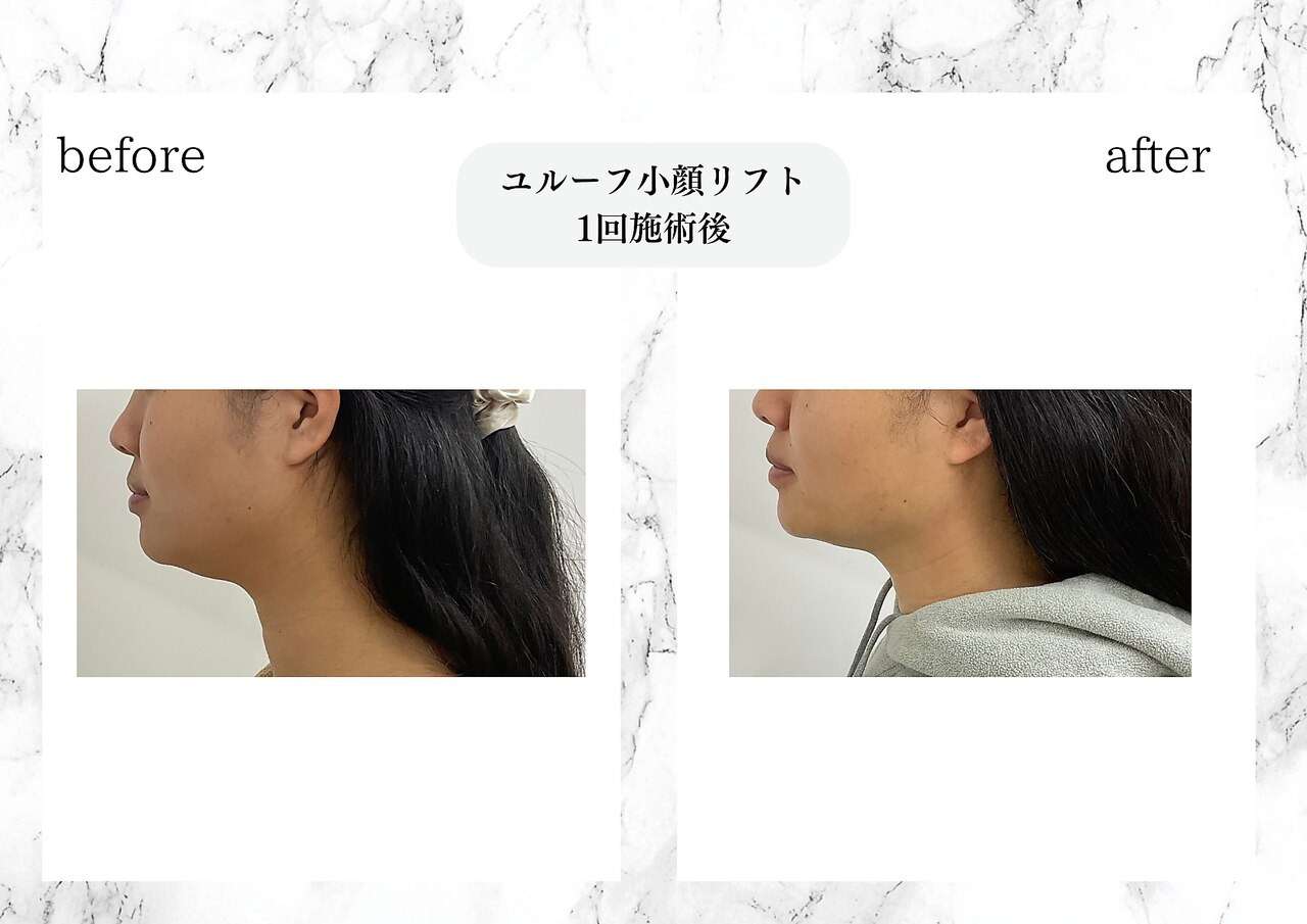 ユルーフ超音波小顔リフト　直後