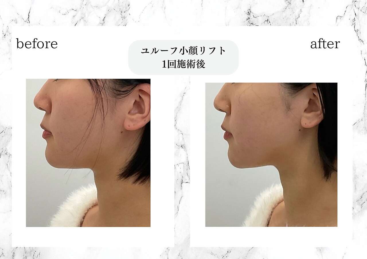 ユルーフ超音波リフト　直後